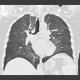 Atypical pneumonia, CMV: CT - Computed tomography
